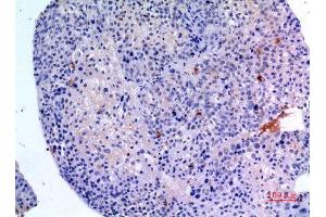 Immunohistochemistry (IHC) analysis of paraffin-embedded Human Liver Cancer, antibody was diluted at 1:100. (BMP3 antibody  (C-Term))