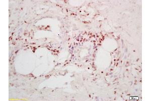 Formalin-fixed and paraffin embedded human colon carcinoma labeled with Anti-TPD52/Prostate and colon associated protein Polyclonal Antibody, Unconjugated (ABIN720745) at 1:200 followed by conjugation to the secondary antibody and DAB staining (TPD52 antibody  (AA 141-190))