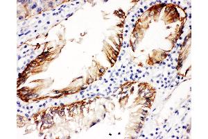 Anti-Integrin beta 4 Picoband antibody,  IHC(P): Human Intestinal Cancer Tissue (Integrin beta 4 antibody  (AA 28-266))