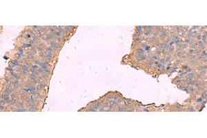 Immunohistochemistry of paraffin-embedded Human liver cancer tissue using KCNN2 Polyclonal Antibody at dilution of 1:65(x200) (KCNN2 antibody)