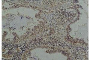 Immunohistochemical analysis of paraffin-embedded Human Lung Caricnoma using Phosphoserine Mouse mAb diluted at 1:200. (Phosphoserine antibody)