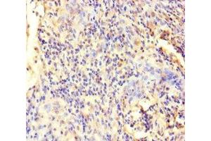Immunohistochemistry of paraffin-embedded human cervical cancer using ABIN7151766 at dilution of 1:100 (ECEL1 antibody  (AA 425-775))