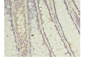 Immunohistochemistry of paraffin-embedded human colon cancer using ABIN7174430 at dilution of 1:100 (UBE2C antibody  (AA 2-179))