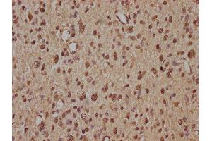 IHC image of ABIN7140239 diluted at 1:100 and staining in paraffin-embedded human glioma performed on a Leica BondTM system. (Znf423 antibody  (AA 39-57))