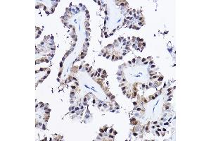 Immunohistochemistry of paraffin-embedded human thyroid cancer using [KO Validated] PDCD4 Rabbit pAb (ABIN3023387, ABIN3023388, ABIN3023389 and ABIN1681284) at dilution of 1:25 (40x lens). (PDCD4 antibody  (AA 1-260))