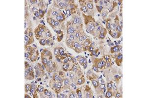 Immunohistochemistry of paraffin-embedded human liver cancer using μgT1A9 antibody (ABIN5970823) at dilution of 1/200 (40x lens).