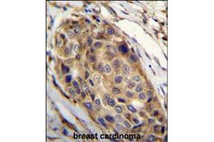 SSH3 Antibody immunohistochemistry analysis in formalin fixed and paraffin embedded human breast carcinoma followed by peroxidase conjugation of the secondary antibody and DAB staining. (SSH3 antibody  (C-Term))
