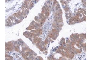 Detection of AST in Human Liver cancer Tissue using Polyclonal Antibody to Aspartate Aminotransferase (AST) (GOT1 antibody  (AA 1-413))