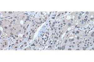 Immunohistochemistry of paraffin-embedded Human esophagus cancer tissue using STRADA Polyclonal Antibody at dilution of 1:45(x200) (STRADA antibody)