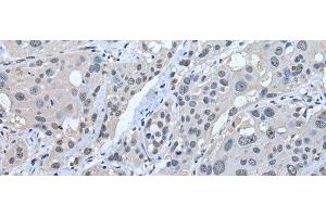 Immunohistochemistry of paraffin-embedded Human esophagus cancer tissue using STRADA Polyclonal Antibody at dilution of 1:45(x200)