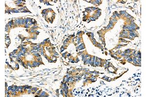 ABIN6260901 and ABIN6276686 at 1/100 staining Human colorectal cancer by IHC-P.