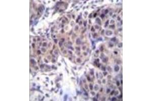 Formalin fixed and paraffin embedded human breast carcinoma reacted with Dishevelled-3 / DVL3 Antibody (C-term) followed by peroxidase conjugation of the secondary antibody and DAB staining. (DVL3 antibody  (C-Term))