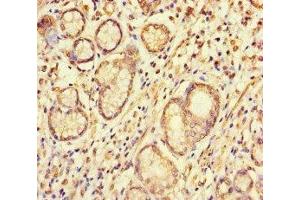 Immunohistochemistry of paraffin-embedded human gastric cancer using ABIN7166087 at dilution of 1:100 (S1G (AA 1-66) antibody)