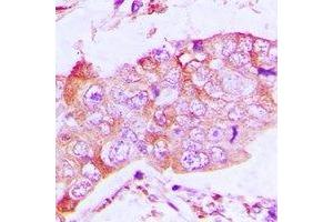 Immunohistochemical analysis of CapG staining in human lung cancer formalin fixed paraffin embedded tissue section. (CAPG antibody)
