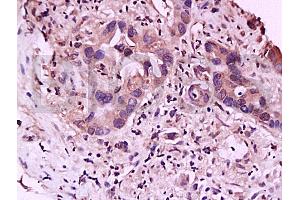 Formalin-fixed and paraffin embedded human gastric carcinoma labeled with Anti-IL-23R Polyclonal Antibody, Unconjugated (ABIN686857) at 1:200 followed by conjugation to the secondary antibody and DAB staining (IL23R antibody  (AA 401-550))