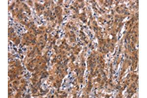 The image on the left is immunohistochemistry of paraffin-embedded Human gastic cancer tissue using ABIN7190640(FDCSP Antibody) at dilution 1/25, on the right is treated with synthetic peptide. (FDCSP antibody)
