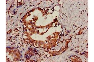 Immunohistochemistry of paraffin-embedded human breast cancer using ABIN7168837 at dilution of 1:100 (SENP2 antibody  (AA 138-324))