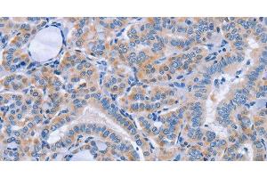Immunohistochemistry of paraffin-embedded Human thyroid cancer using CD36 Polyclonal Antibody at dilution of 1:60 (CD36 antibody)
