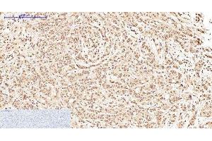 Immunohistochemistry of paraffin-embedded Human breast cancer tissue using Oct-1/2 Monoclonal Antibody at dilution of 1:200.