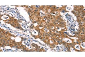 Immunohistochemistry of paraffin-embedded Human gasrtic cancer tissue using CYLD Polyclonal Antibody at dilution 1:35 (CYLD antibody)