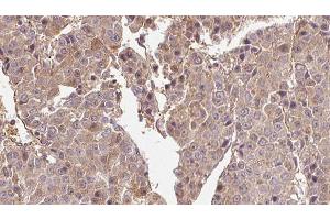 ABIN6274569 at 1/100 staining Human liver cancer tissue by IHC-P.
