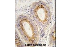 Forlin-fixed and paraffin-embedded hun colon carcino tissue reacted with RS2 antibody (C-term) (ABIN392309 and ABIN2841960) , which was peroxidase-conjugated to the secondary antibody, followed by DAB staining.