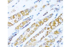 Immunohistochemistry of paraffin-embedded Human gastric cancer using NDUFA5 Polyclonal Antibody at dilution of 1:100 (40x lens). (NDUFA5 antibody)