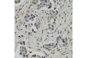 Immunohistochemistry of paraffin-embedded human breast cancer using INTS6 Antibody (ABIN2563455) at dilution of 1:100 (40x lens). (INTS6 antibody)