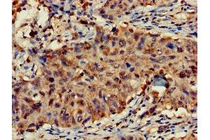 Immunohistochemistry of paraffin-embedded human lung cancer using ABIN7143032 at dilution of 1:100 (FAM17A (AA 1-144) antibody)