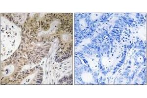 Immunohistochemistry analysis of paraffin-embedded human colon carcinoma tissue, using PRPF6 Antibody.