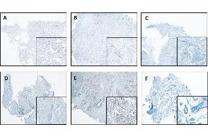 CTSL expression in normal and tumor tissues of the lung and breast. (Cathepsin L antibody  (AA 114-288))