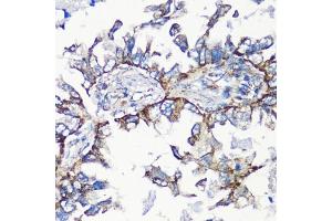 Immunohistochemistry of paraffin-embedded human lung cancer using MMP16 antibody (ABIN6132356, ABIN6143906, ABIN6143907 and ABIN6214654) at dilution of 1:100 (40x lens). (MMP16 antibody  (AA 290-565))