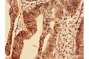 Immunocytochemistry analysis of human colon cancer using ABIN7172795 at dilution of 1:100 (Transferrin Receptor antibody  (AA 94-754))