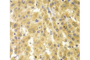 Immunohistochemistry of paraffin-embedded Human liver cancer using GMNN Polyclonal Antibody at dilution of 1:100 (40x lens). (Geminin antibody)