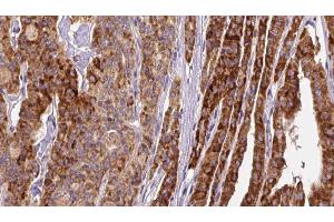 ABIN6267145 at 1/100 staining Human thyroid cancer tissue by IHC-P. (GRIN2B antibody  (pSer1284))