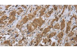 Immunohistochemistry of paraffin-embedded Human breast cancer tissue using CLPS Polyclonal Antibody at dilution 1:45 (CLPS antibody)