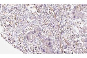 ABIN6273953 at 1/100 staining Human liver cancer tissue by IHC-P. (NPY4R antibody  (N-Term))