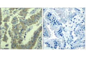 Immunohistochemical analysis of paraffin-embedded human lung carcinoma tissue using MARCKS (phospho-Ser170) Antibody (E011535). (MARCKS antibody  (pSer170))