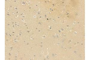 ABIN6264565 and ABIN6279732 at 1/100 staining human glioblastoma by IHC-P. (RAB23 antibody  (C-Term))