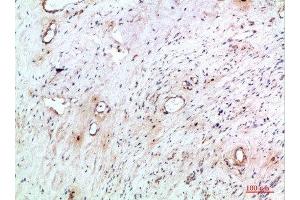 Immunohistochemical analysis of paraffin-embedded human-cervical-cancer, antibody was diluted at 1:200 (TNIP2 antibody  (AA 61-110))