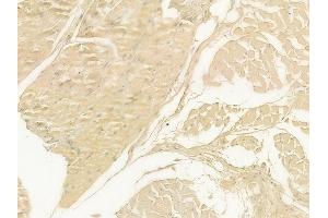 ABIN6262540 and ABIN6278895 at 1/100 staining human tongue carcinoma by IHC-P. (IL17F antibody  (Internal Region))