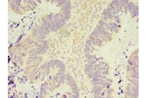 Immunohistochemistry of paraffin-embedded human ovarian cancer using ABIN7165911 at dilution of 1:100 (PELO antibody  (AA 1-385))