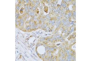 Immunohistochemistry of paraffin-embedded human colon carcinoma using PSG1 antibody.