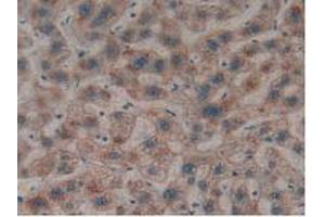 IHC-P analysis of Human Liver Cancer Tissue, with DAB staining. (LGALS8 antibody  (AA 1-317))