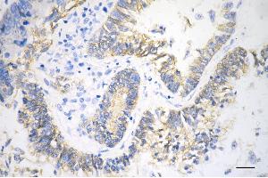 Immunohistochemistry was performed on paraffin-embedded human sigmoid colon carcinoma using catenin beta 1 antibody (ABIN7797929), 1:100). (CTNNB1 antibody)