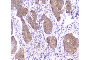 IHC testing of FFPE human breast cancer with SMN1/2 antibody. (SMN1 / SMN2 antibody)