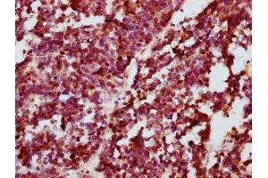 IHC image of ABIN7127685 diluted at 1:100 and staining in paraffin-embedded human lung cancer performed on a Leica BondTM system. (Recombinant CREB1 antibody  (pSer133))