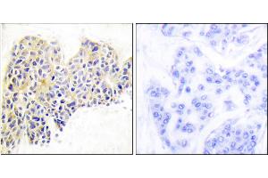 Immunohistochemical analysis of paraffin-embedded human breast carcinoma tissue using HSP90B (Ab-254) antibody. (HSP90AB1 antibody)