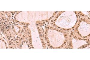 Immunohistochemistry of paraffin-embedded Human thyroid cancer tissue using KDM7A Polyclonal Antibody at dilution of 1:35(x200) (JHDM1D antibody)