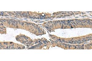 Immunohistochemistry of paraffin-embedded Human colorectal cancer tissue using ZG16 Polyclonal Antibody at dilution of 1:95(x200) (ZG16 antibody)